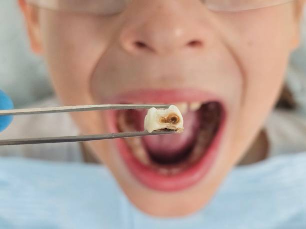 Best Emergency Treatment for Dental Infections or Abscesses in Gorevle, IL